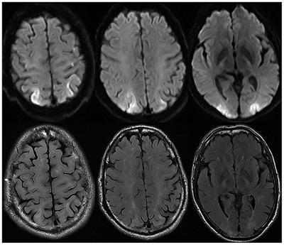 Case Report: PRES-Like Syndrome With Reversible Cortical Blindness Associated With Essential Thrombocythemia